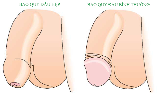 5cbadb930f664a80664c209a hep bao quy dau o nguoi lon
