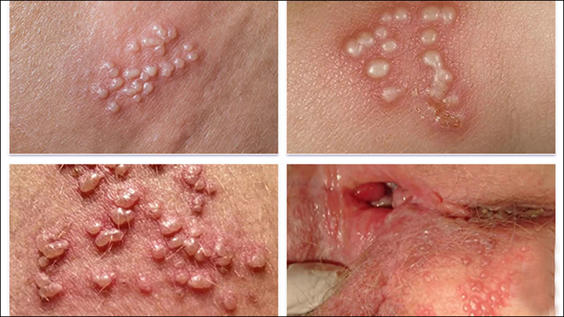 6 dau hieu mun rop herpes sinh duc ban khong the bo qua 1 800x450