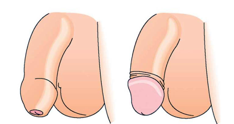 Bao quy dau dai