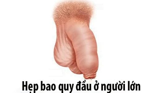 Hien tuong hep bao quy dau ơ nam gioi