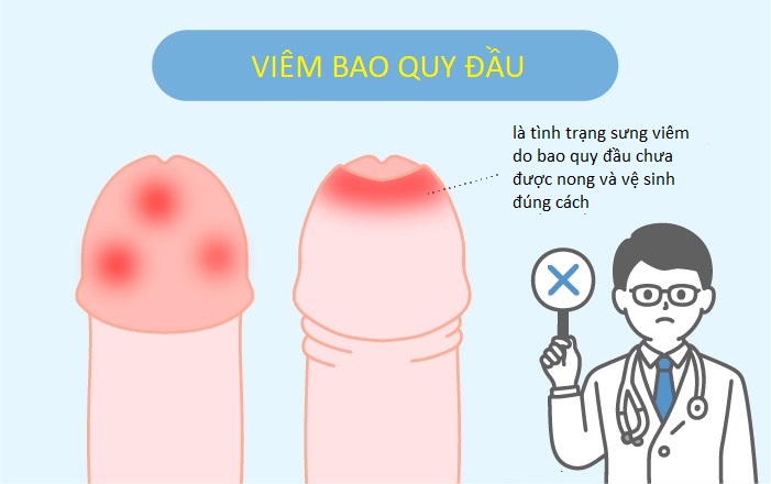 Viem bao quy dau o tre em