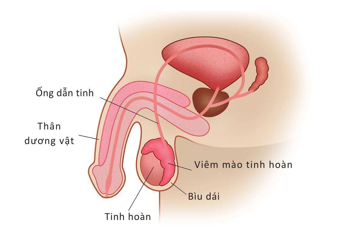 Tinh trang viem nhiem mao tinh hoan
