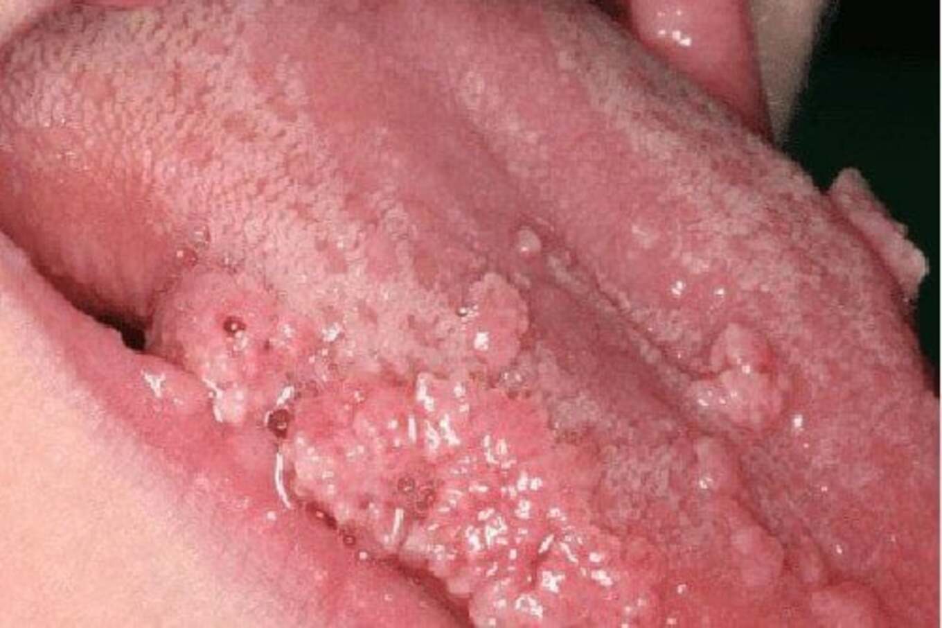 Bị sùi mào gà ở lưỡi: Điều trị thế nào để hiệu quả và an toàn?