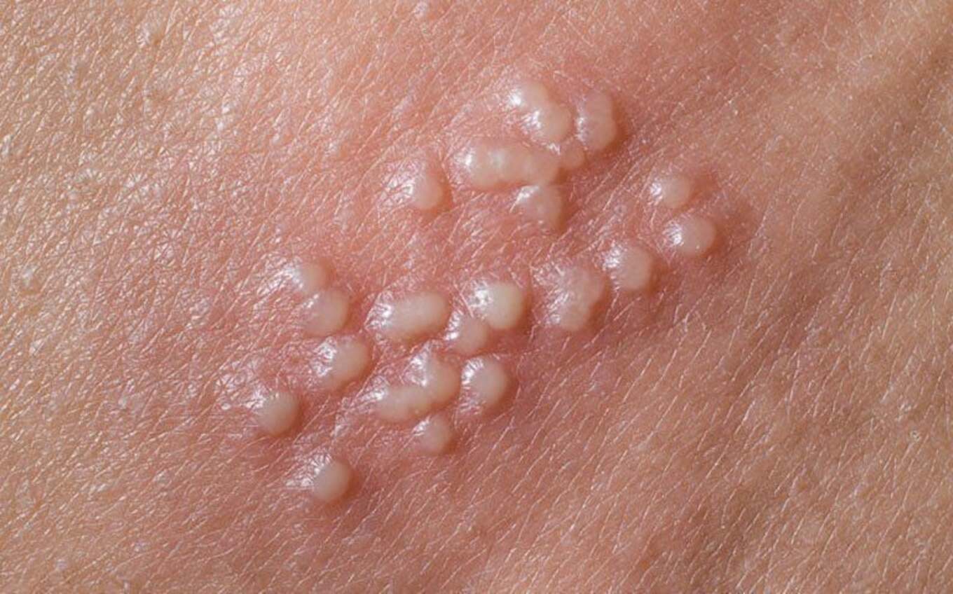 Phân biệt mụn cóc sinh dục và mụn rộp sinh dục