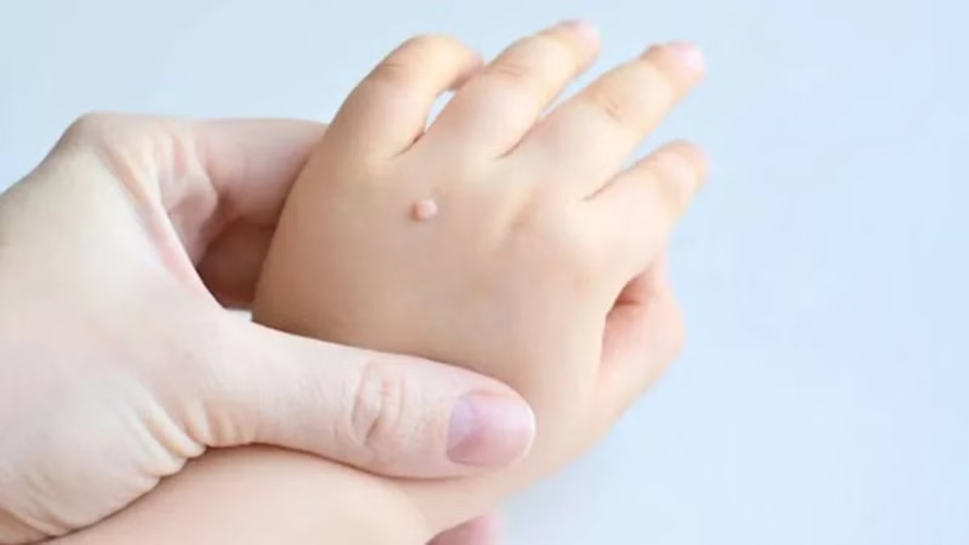 Trẻ bị sùi mào gà – Cha mẹ sốc nặng! Bệnh lây truyền từ đâu?