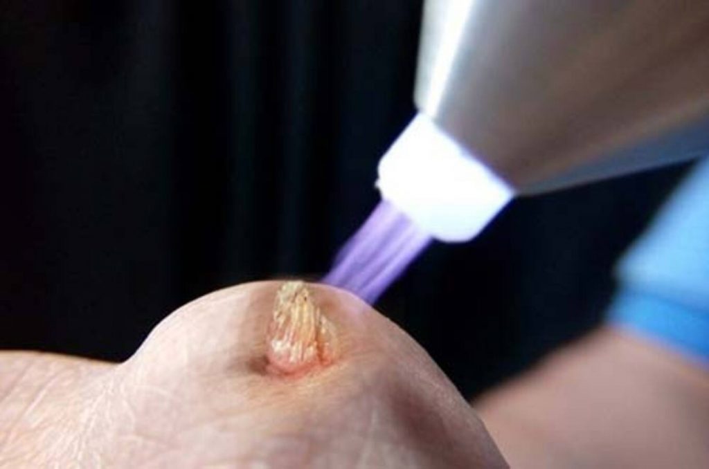 Những điều cần lưu ý khi điều trị đốt sùi mào gà