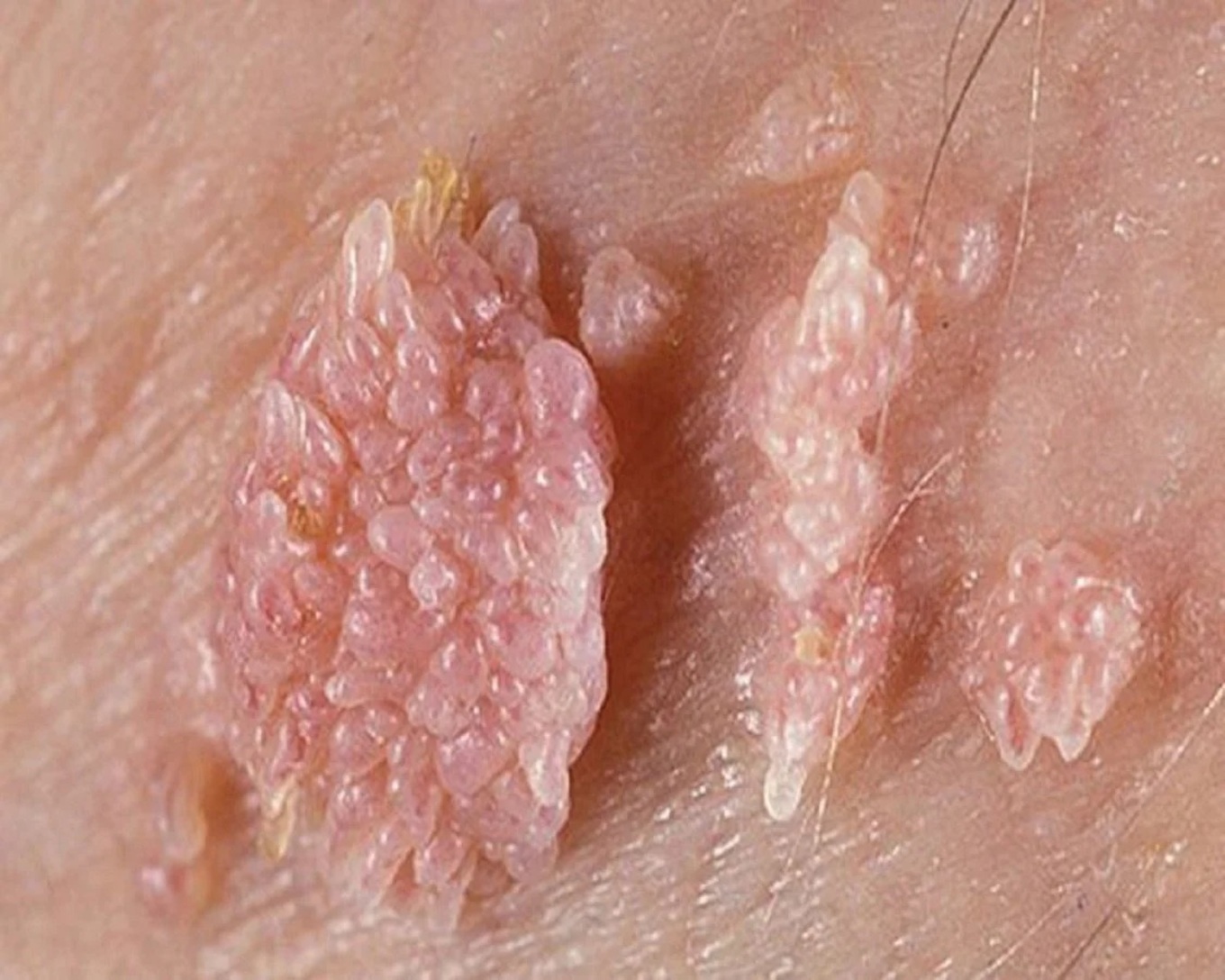 Sùi mào gà tái phát không phải do bác sĩ kém – mà là vì bạn chưa hiểu hết cách mà virus HPV hoạt động trong cơ thể!