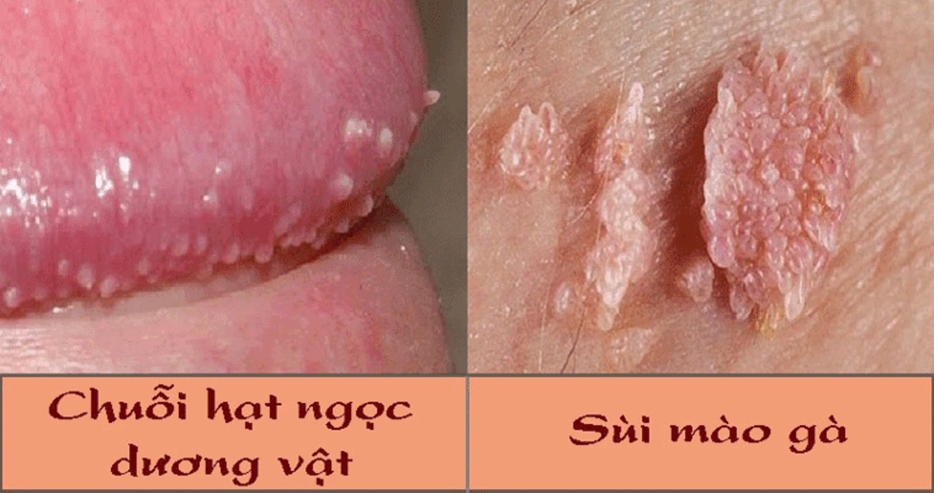 Chuỗi Hạt Ngọc Dương Vật-Hiểu Đúng Để Bớt Lo, Biết Khi Nào Cần Can Thiệp!!!