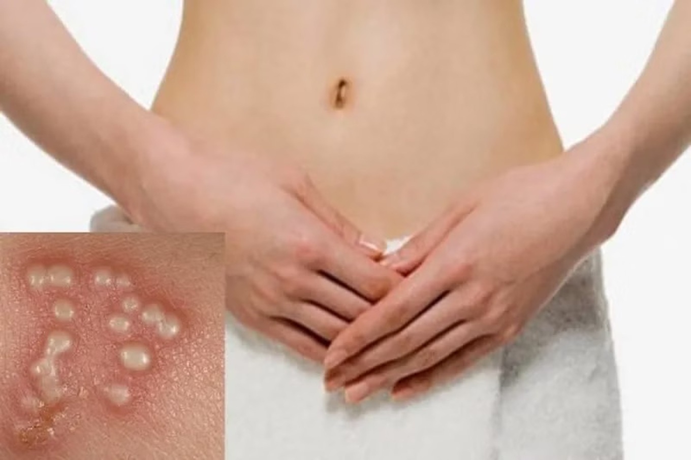 Các giai đoạn phát triển của mụn rộp sinh dục (Herpes)