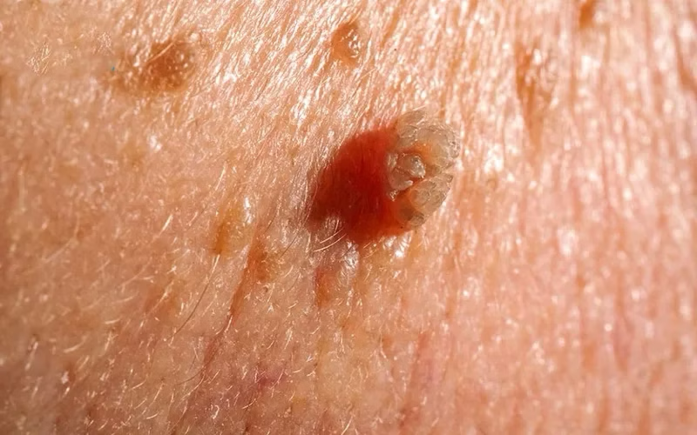 Sùi mào gà tái phát không phải do bác sĩ kém – mà là vì bạn chưa hiểu hết cách mà virus HPV hoạt động trong cơ thể!