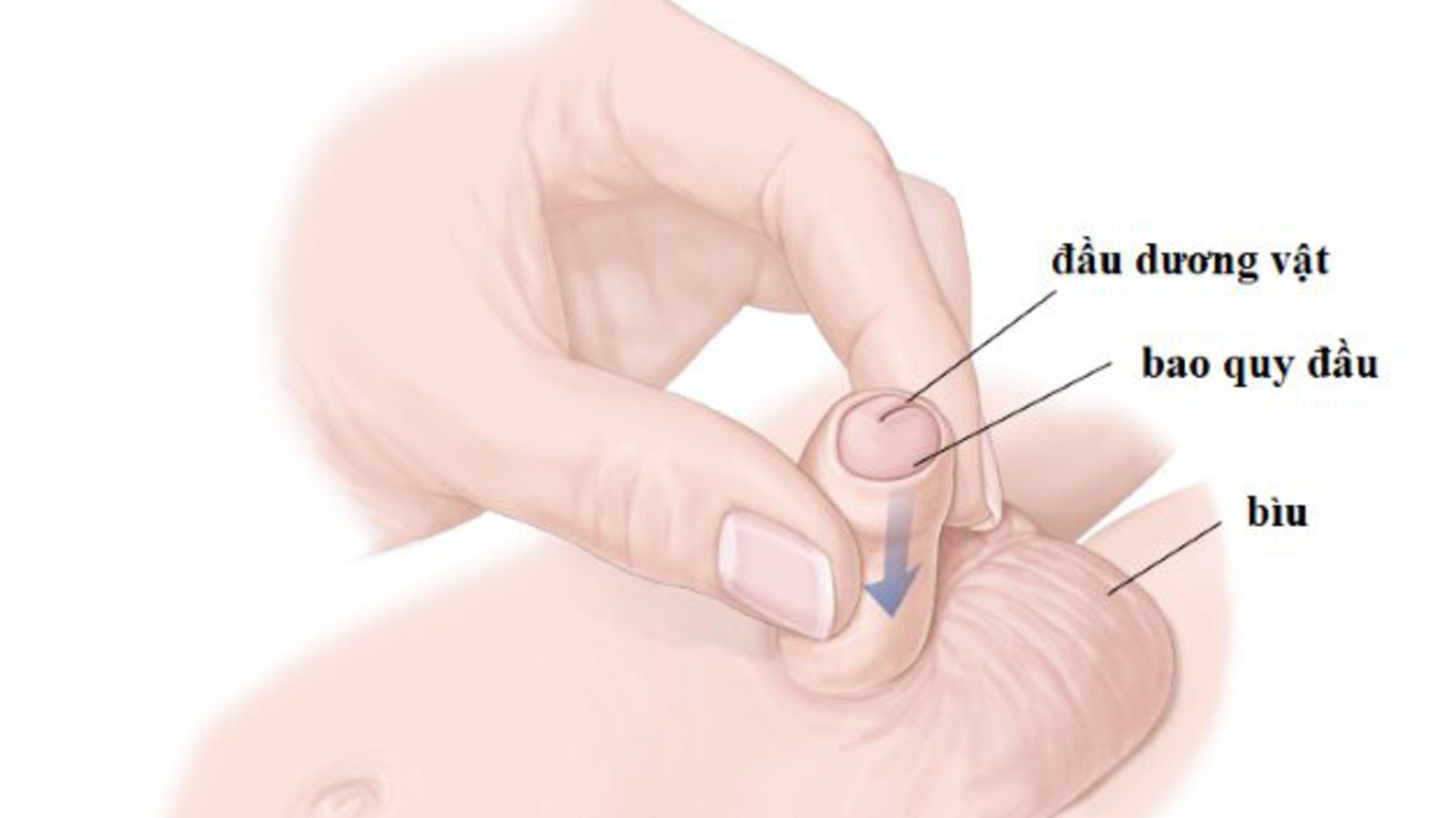 HẸP BAO QUY ĐẦU Ở TRẺ EM!! KHI NÀO CẦN CAN THIỆP!?