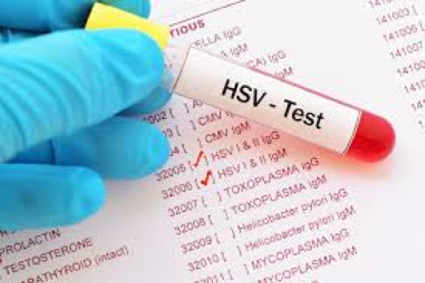 Không triệu chứng vẫn nhiễm Herpes! Xét nghiệm sớm để biết bạn có đang mang virus?
