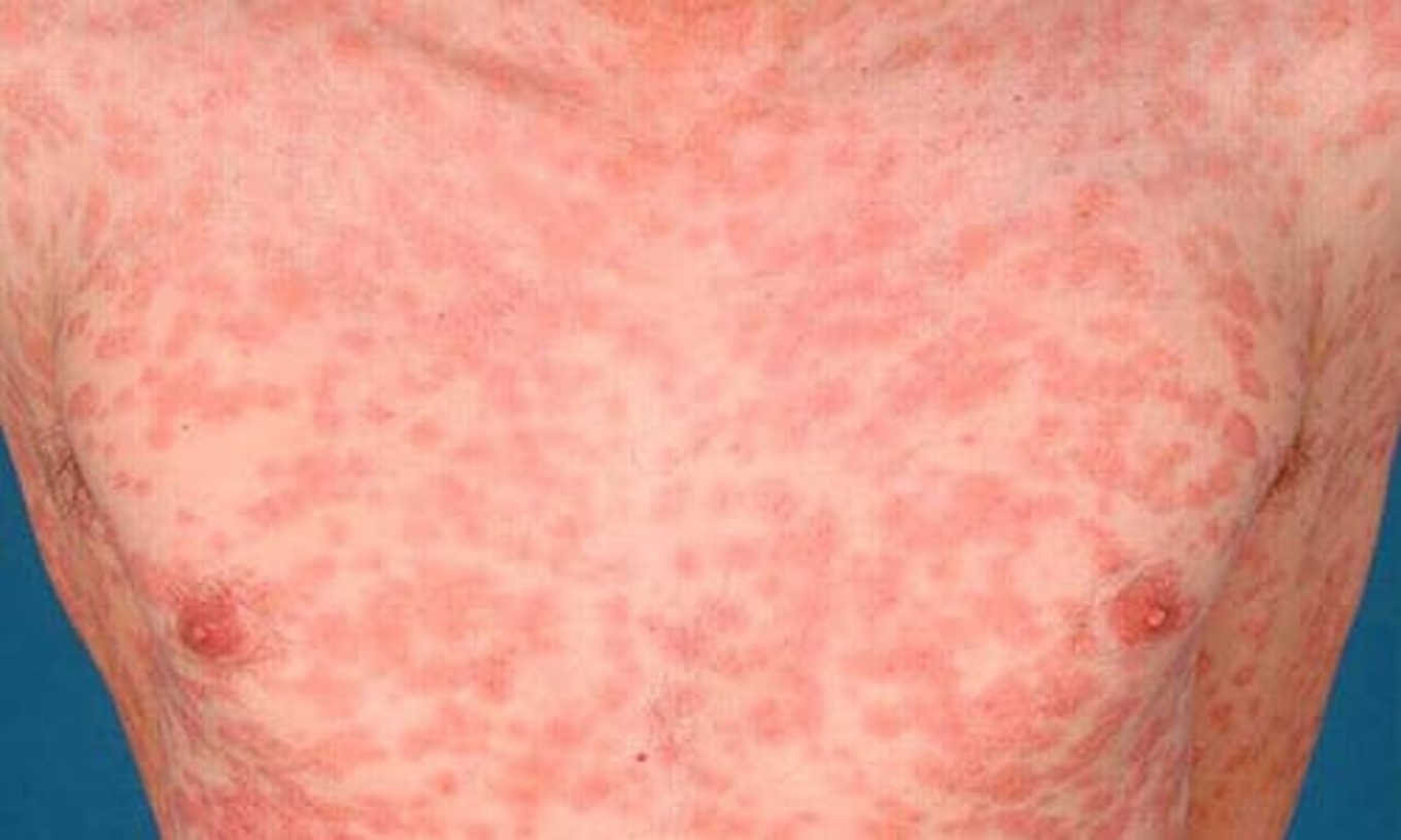 Phát Ban Toàn Thân-Triệu Chứng Giang Mai Giai Đoạn 2!!