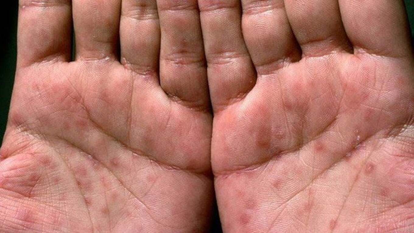 Phát Ban Toàn Thân-Triệu Chứng Giang Mai Giai Đoạn 2!!