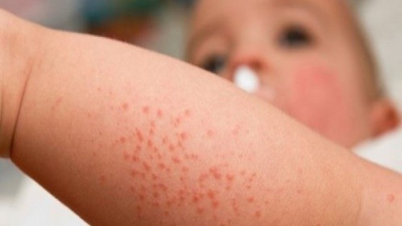 Trẻ bị sùi mào gà – Cha mẹ sốc nặng! Bệnh lây truyền từ đâu?