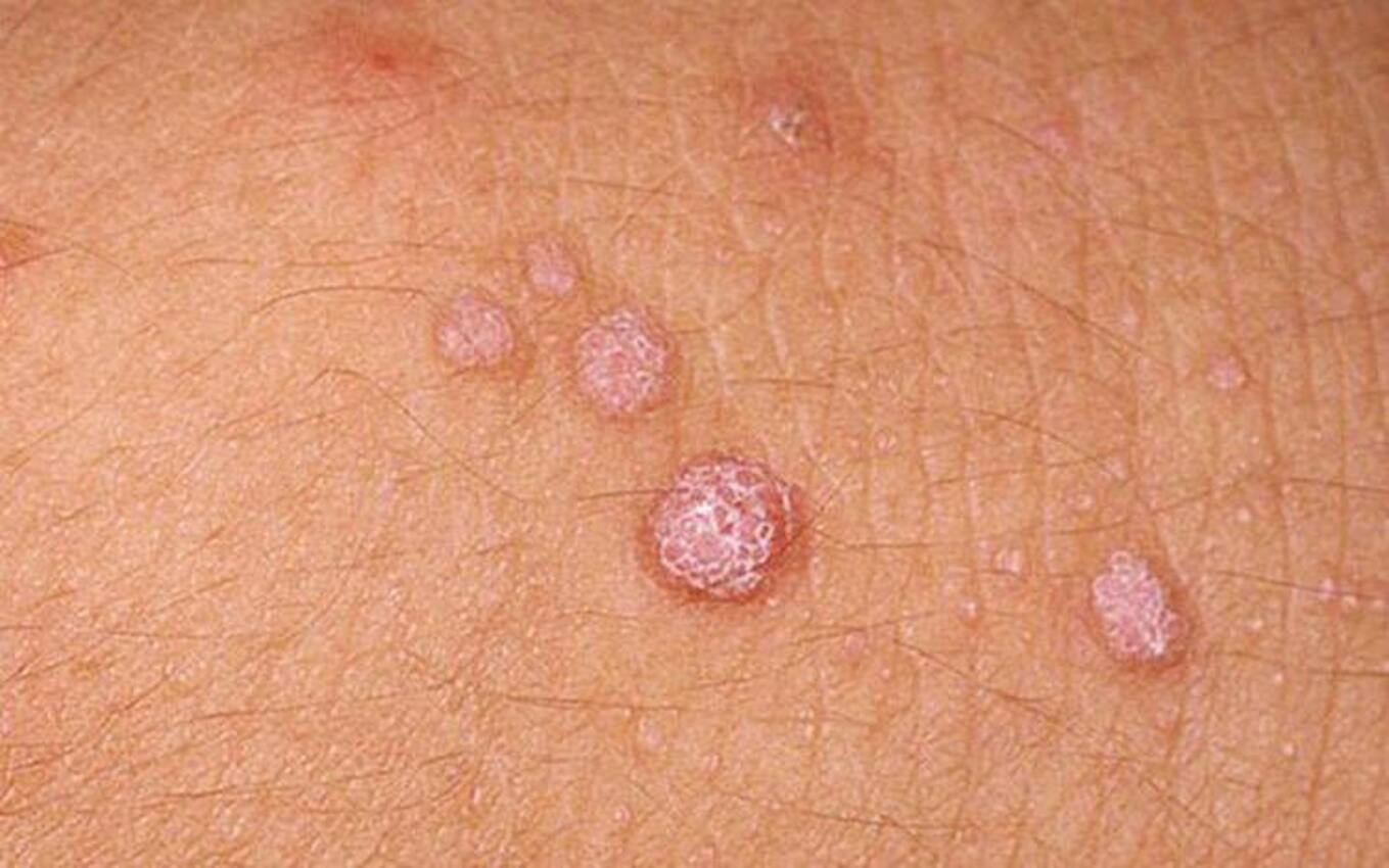 Phân biệt mụn cóc sinh dục và mụn rộp sinh dục