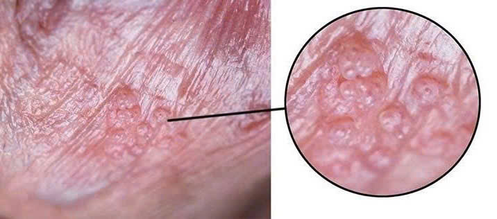 Ám ảnh kinh hoàng vì sùi mào gà ở tuổi 22 – Chỉ sau một lần chủ quan